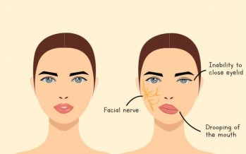 ما هو شلل الوجه النصفى وأعراض الإصابة به؟