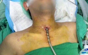 عملية نوعية في مستشفى الشيخ راغب حرب لإزالة تضتيق بالقصبة الهوائية