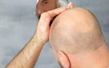 الصلع يزيد احتمال نقل مرضى 
