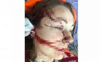 بسبب غيرته القاتلة... رجل يطعن زوجته في وجهها!