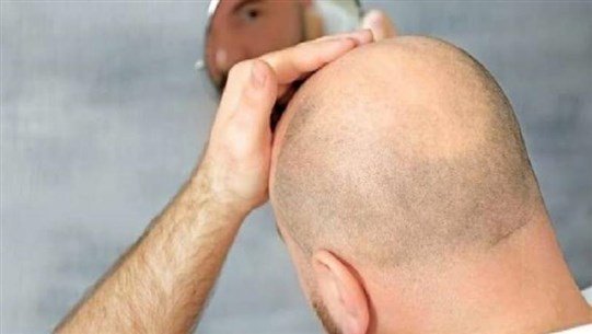 الصلع يزيد احتمال نقل مرضى الصلع يزيد احتمال نقل مرضى