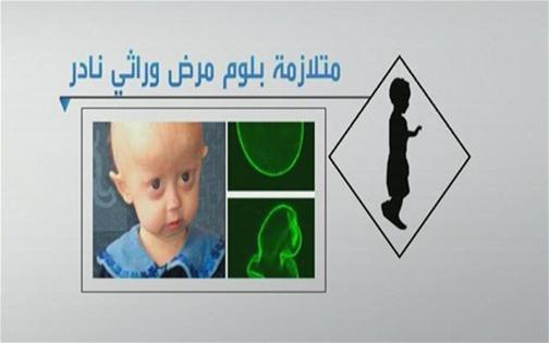 السماح باختبار لمعرفة توارث الأطفال لـ«بلوم» السماح باختبار لمعرفة توارث الأطفال لـ«بلوم»