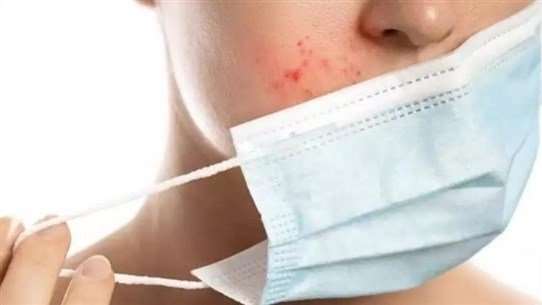 كيفية الوقاية من الحبوب الناتجة عن وضع الكمامة كيفية الوقاية من الحبوب الناتجة عن وضع الكمامة