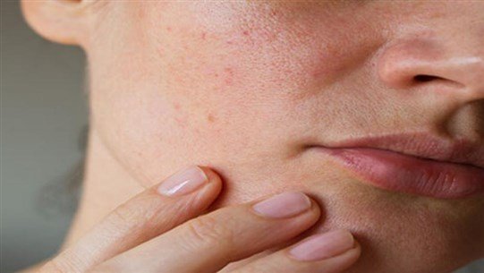 أفضل علاج للبشرة من حبّ الشباب أفضل علاج للبشرة من حبّ الشباب