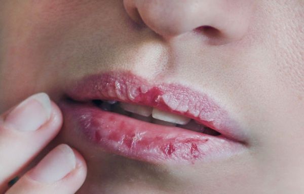 تشقق الشفاه في الشتاء.. 5 نصائح للعلاج تشقق الشفاه في الشتاء.. 5 نصائح للعلاج