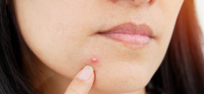منها معجون الأسنان.. 10 طرق للتخلص من البثور المفاجئة منها معجون الأسنان.. 10 طرق للتخلص من البثور المفاجئة