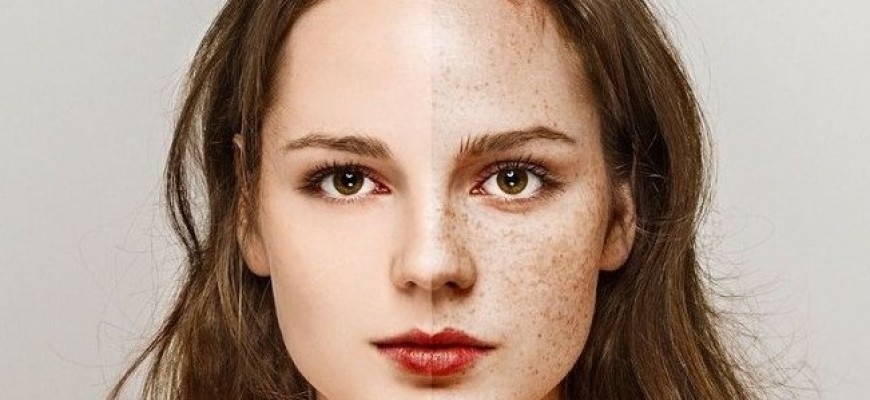 وصفات طبيعية رائعة للتخلص من النمش وصفات طبيعية رائعة للتخلص من النمش