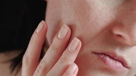 مشكلة جماليّة شائعة.. هكذا تتخلّصين منها مشكلة جماليّة شائعة.. هكذا تتخلّصين منها