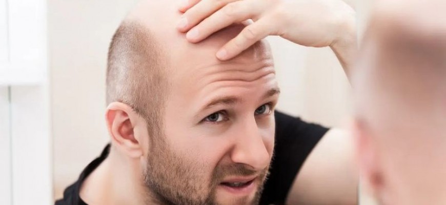 قائمة الدول الأكثر انتشارًا للصلع لدى الرجال وقلقهم من هذه الظاهرة قائمة الدول الأكثر انتشارًا للصلع لدى الرجال وقلقهم من هذه الظاهرة
