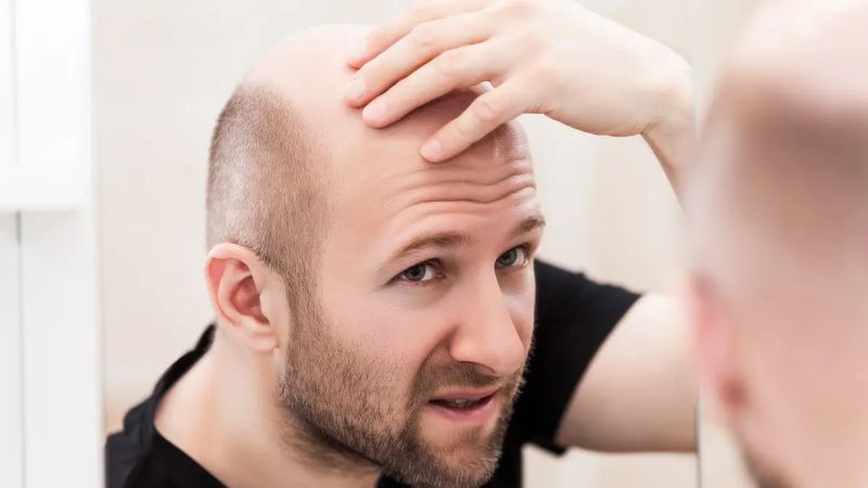 قائمة الدول الأكثر انتشارًا للصلع لدى الرجال وقلقهم من هذه الظاهرة